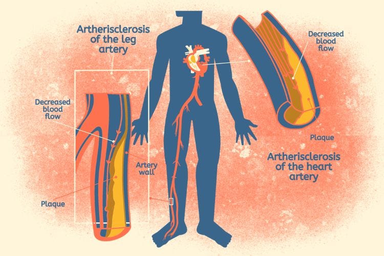 Atherosclerosis