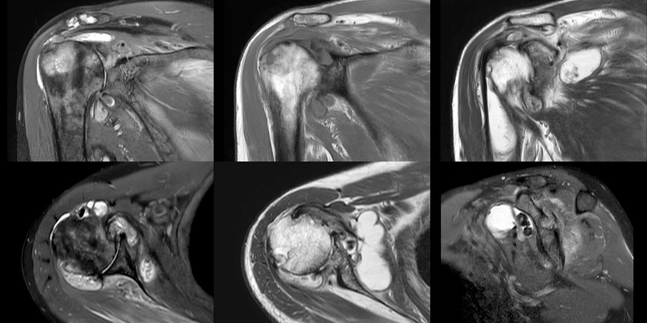 Case 58: A Milwaukee Shoulder in Mumbai