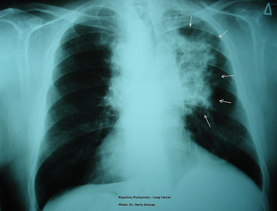 File:Lung cancer in xray.jpg