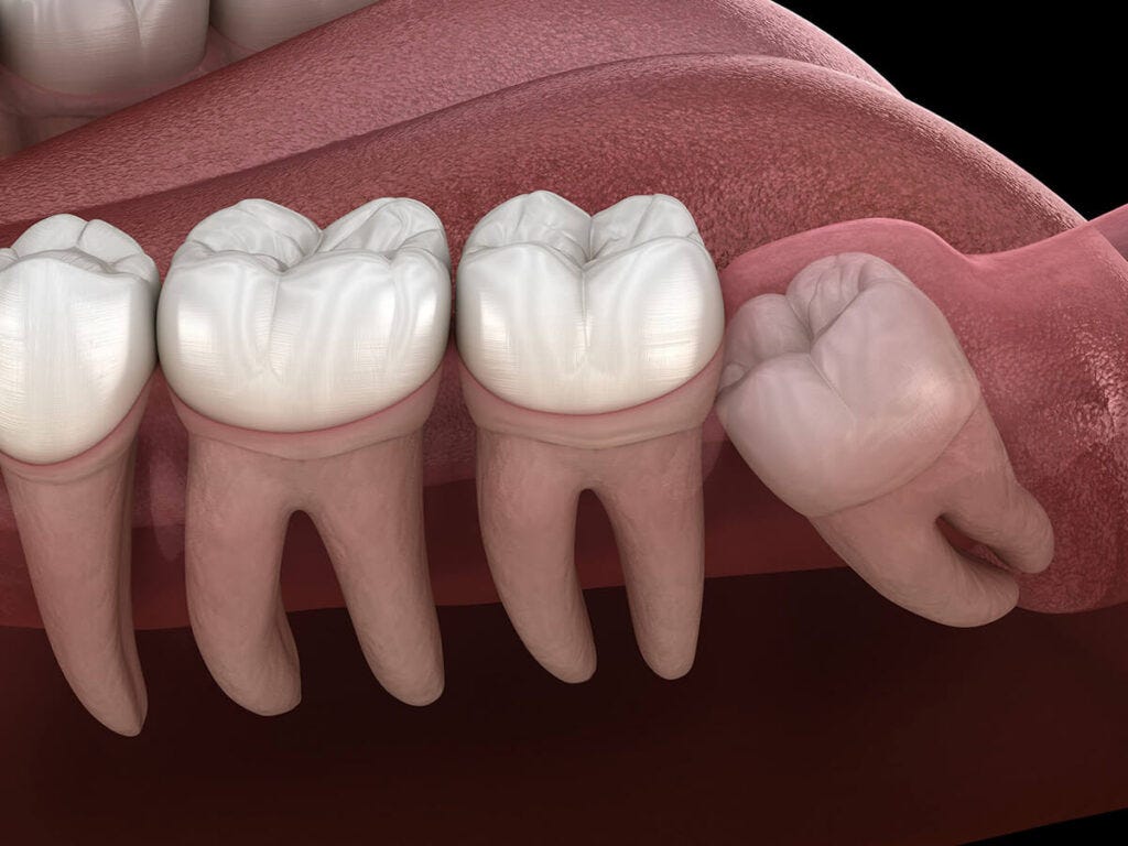 Wisdom Teeth Removal - Allen Park, MI - Tally Dental Excellence