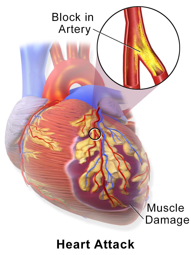 Avoiding holiday heart syndrome - Greg Katz, MD