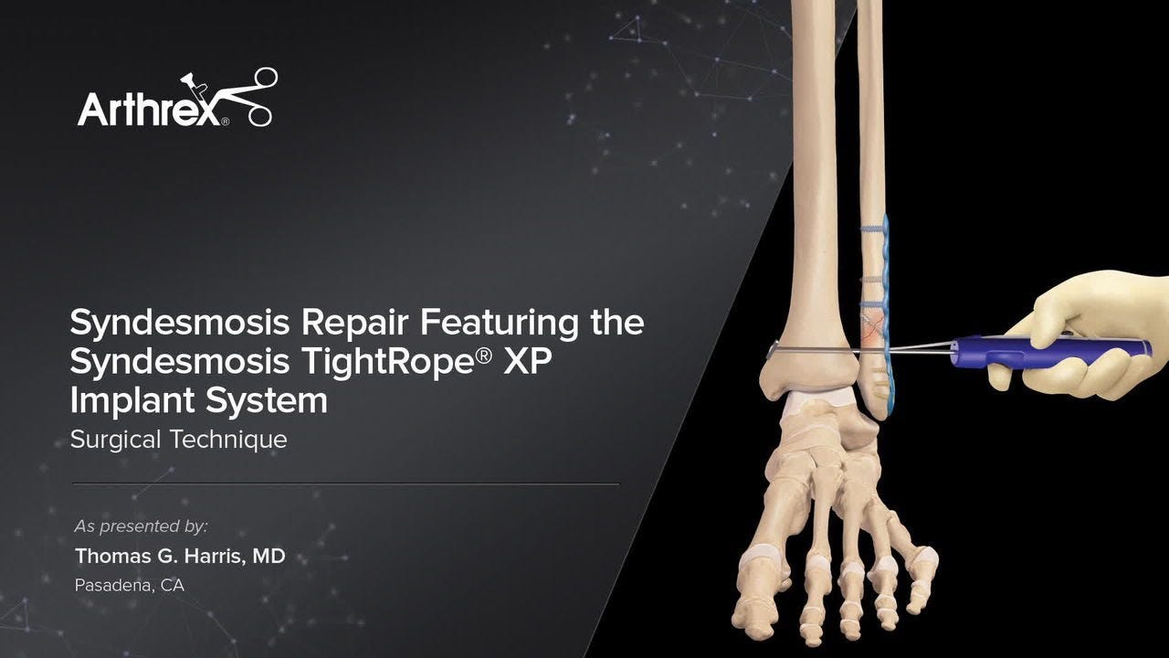 Syndesmosis Repair Featuring the Syndesmosis TightRope® XP Implant System -  YouTube
