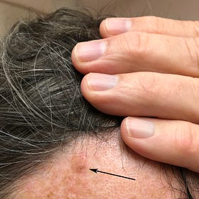 Case Report: Squamous Cell Carcinoma, Male, age 63
