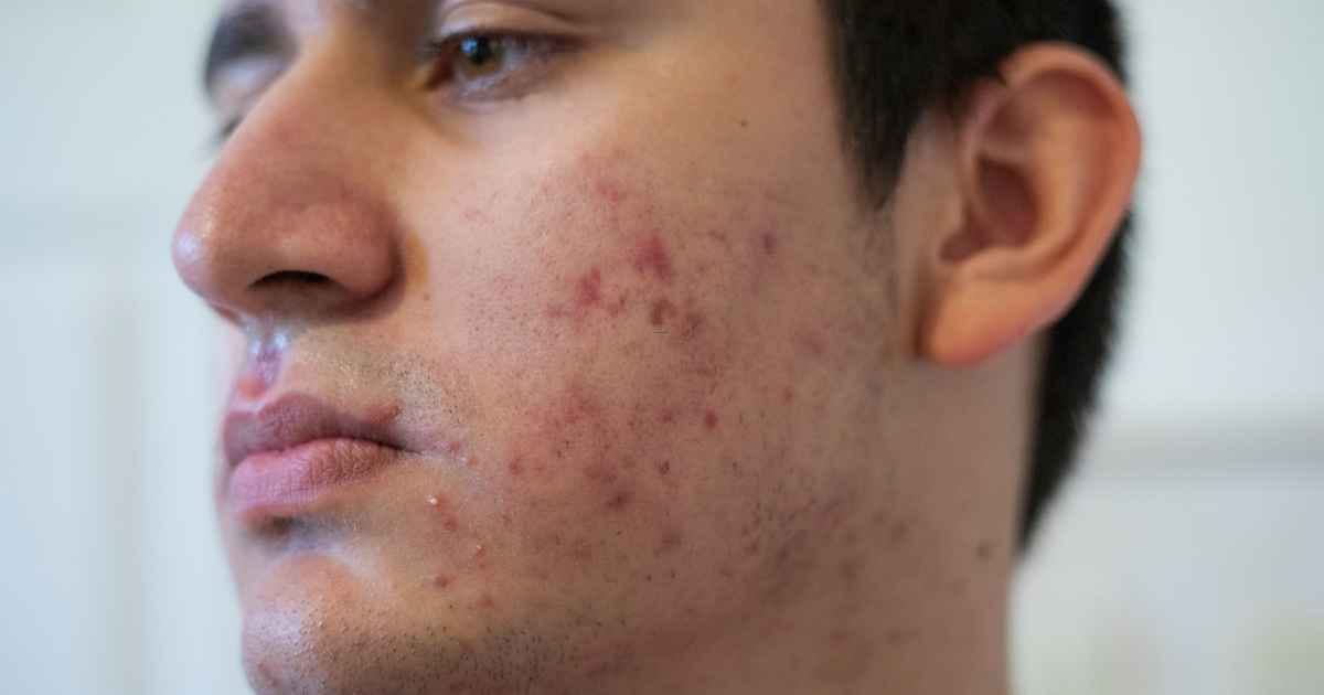 young man with acne