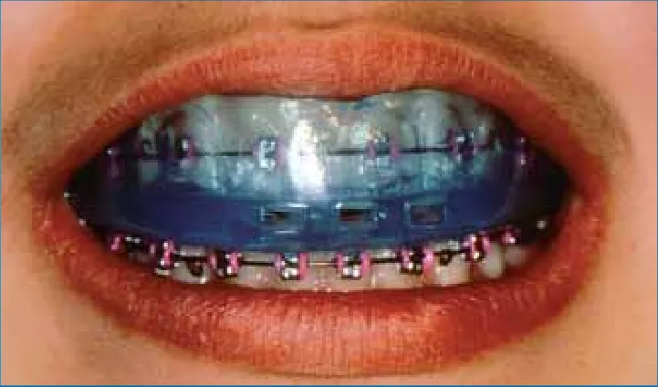 mouthguard for braces