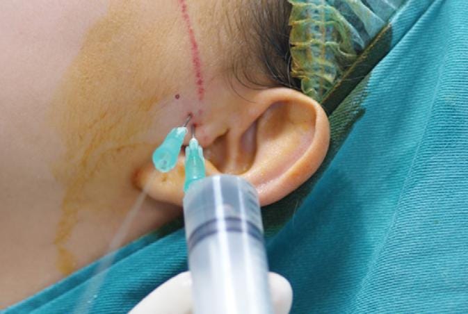 TMJ Arthrocentesis – Exodontia