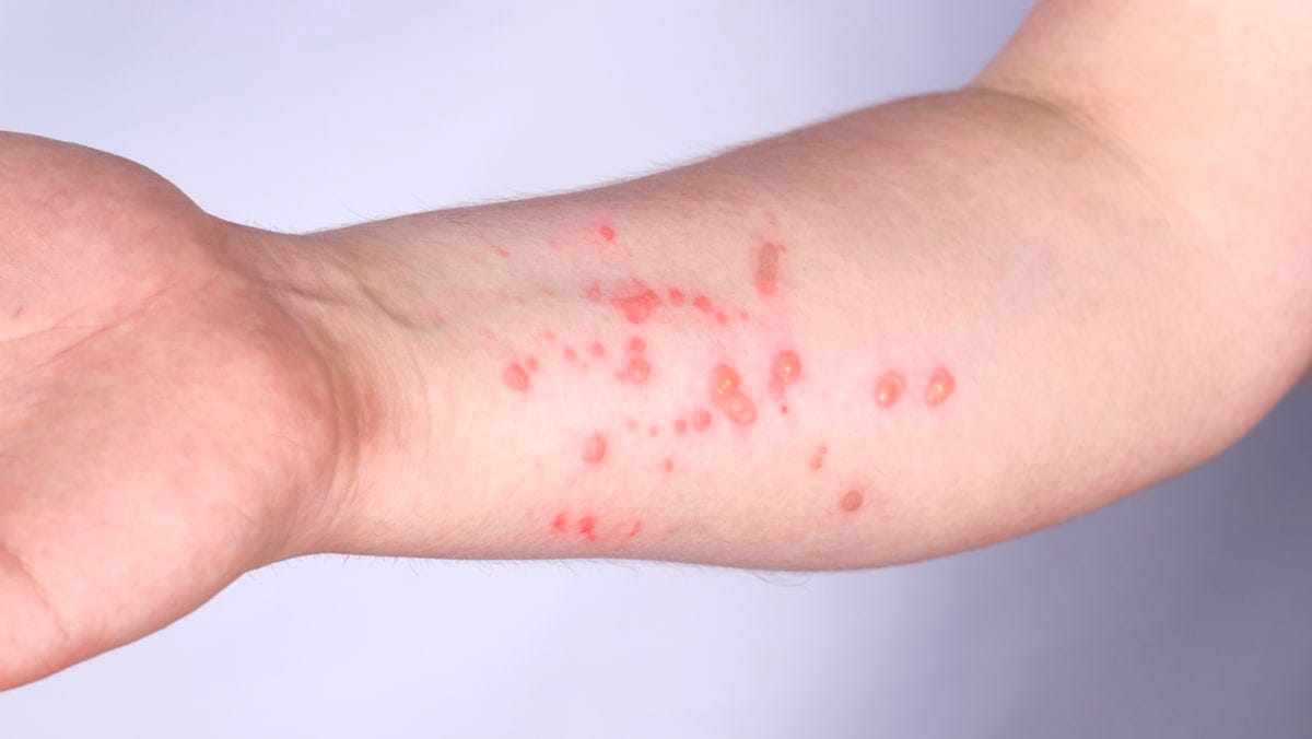What is it like to have monkeypox? Patients share their experience - CNA