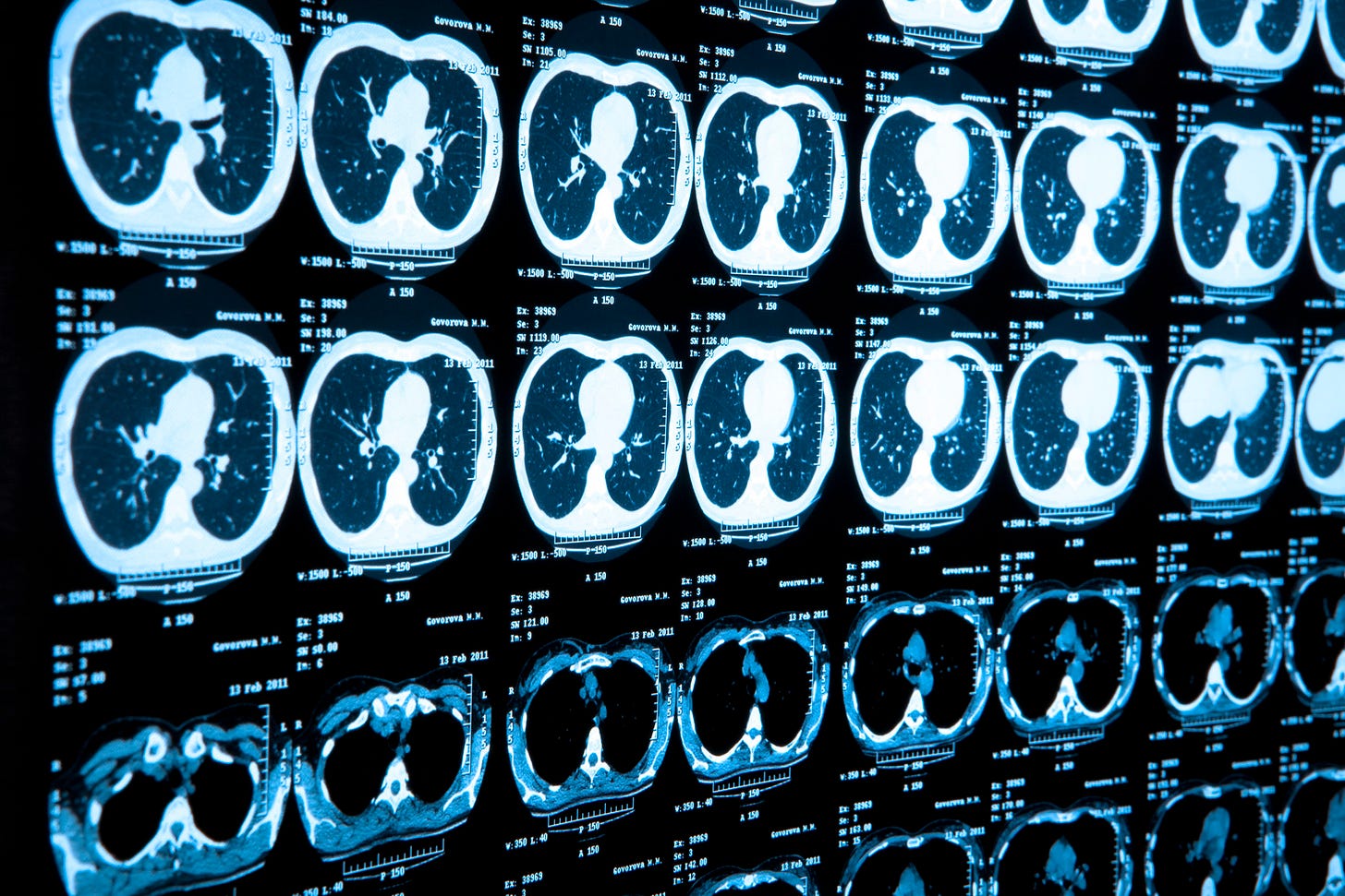 Artificial Intelligence System Spots Lung Cancer Before Radiologists - News  Center