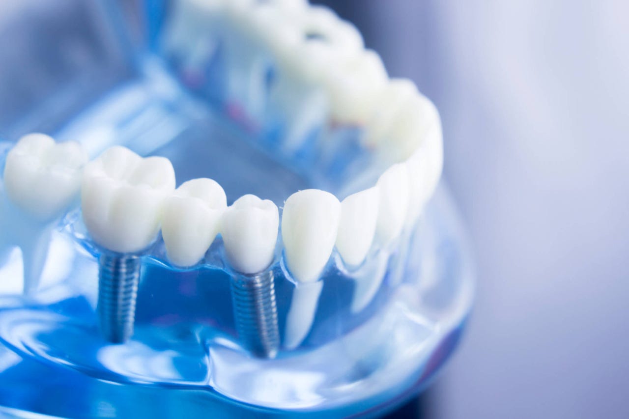 Implantodontia – Clínica Atenta Odontologia Sistêmica