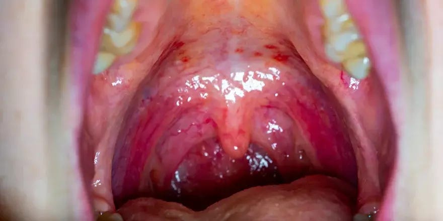 What Does Strep Throat Look Like? - Xpress Wellness Urgent Care What Does Strep Throat Look Like? - Xpress Wellness Urgent Care