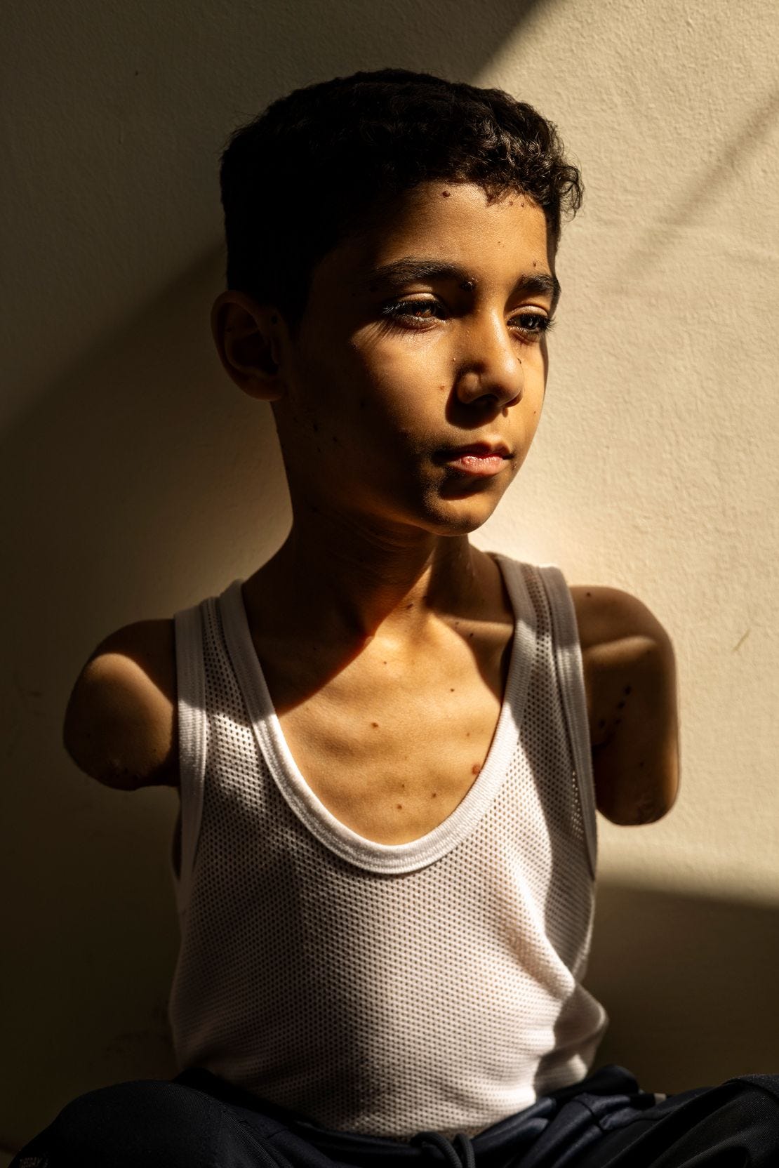 "Mahmoud Ajjour, Aged Nine." Mahmoud Ajjour, who was injured during an Israeli attack on Gaza City in March 2024, finds refuge and medical help in Doha, Qatar, on June 28, 2024. "Mahmoud Ajjour, Aged Nine." Mahmoud Ajjour, who was injured during an Israeli attack on Gaza City in March 2024, finds refuge and medical help in Doha, Qatar, on June 28, 2024.