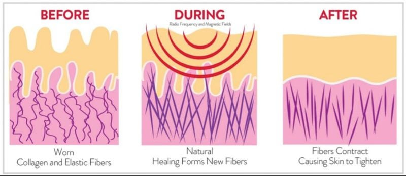r/30PlusSkinCare - My Guide to Cosmetic Lasers and Laser Skin Resurfacing