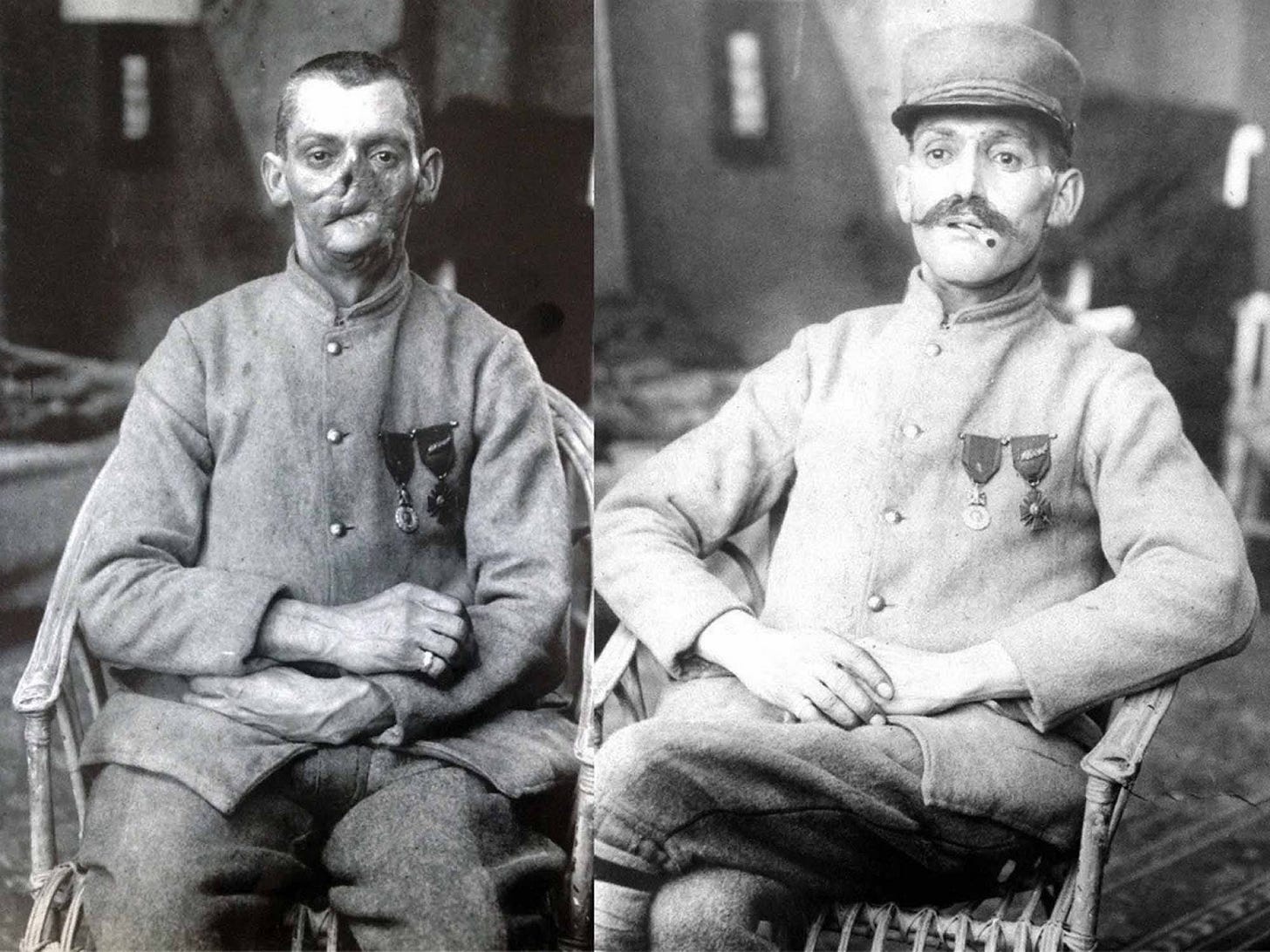 The part of the soldier's body that was most vulnerable was his face, because if he looked up over a trench, that was the part that was going to be hit. T