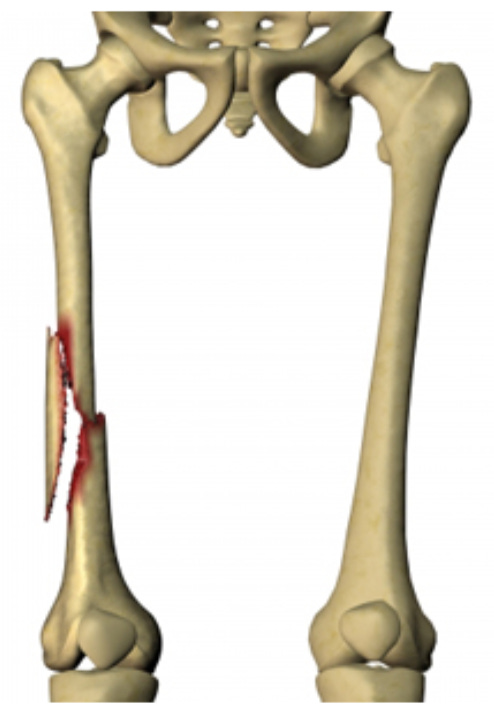 Open Reduction and Closed Reduction Internal Fixation: Pros and Cons