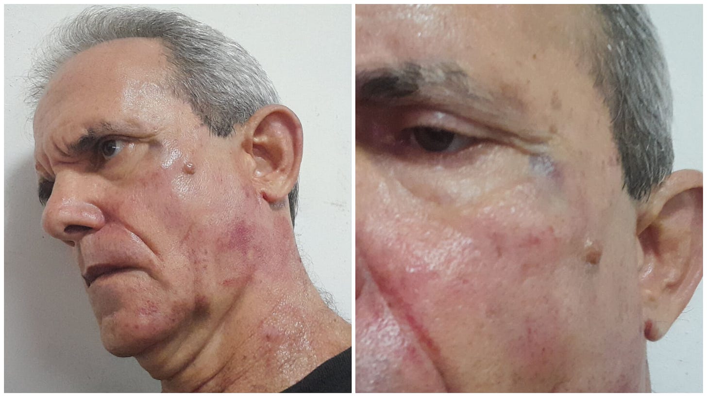 A person with a rash on his face

AI-generated content may be incorrect.