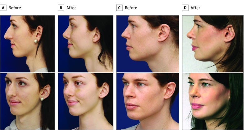 An external file that holds a picture, illustration, etc.
Object name is jamafacialplastsurg-19-175-g005.jpg