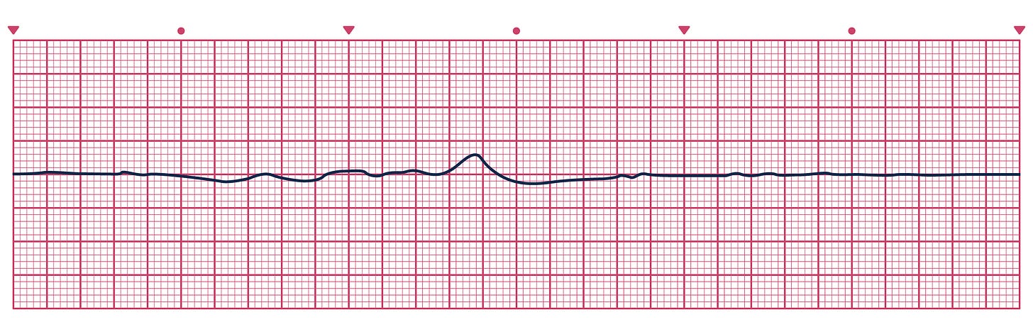 An ECG depicting Asystole