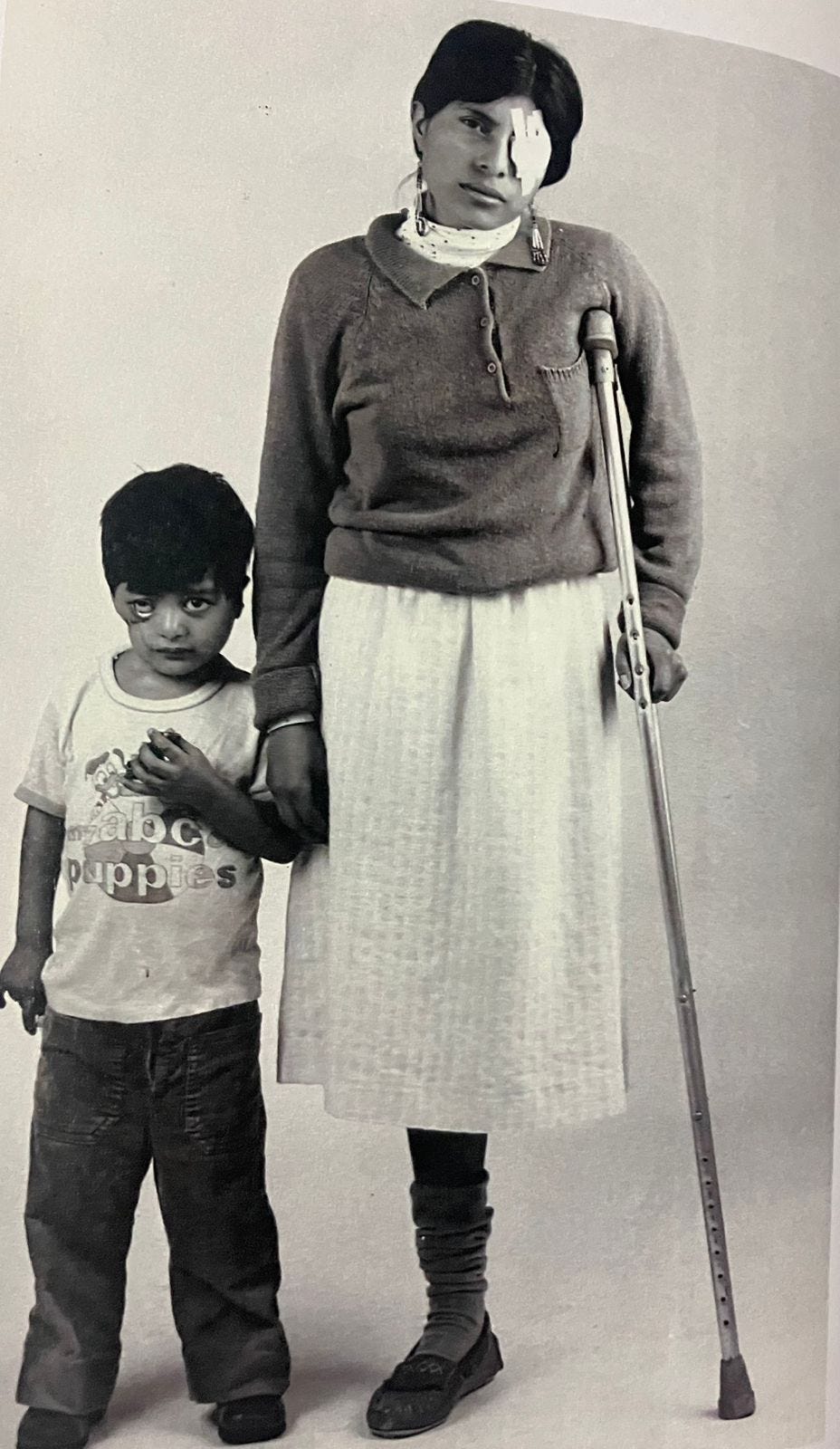 A young boy with an injury to his eye stands next to a young woman with one leg who has a crutch and is wearing an eye bandage. Photo: S. Brian Willson.