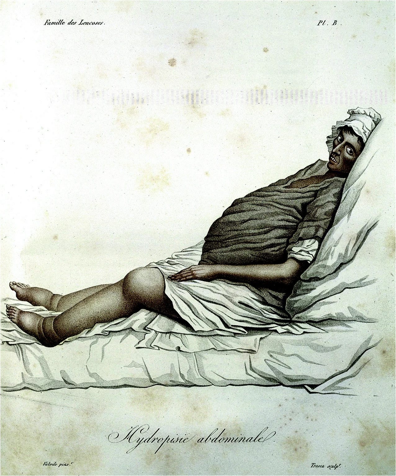 Old medical illustration of a person with dropsy. Her belly, legs and knees are very distended, and her face is gaunt.