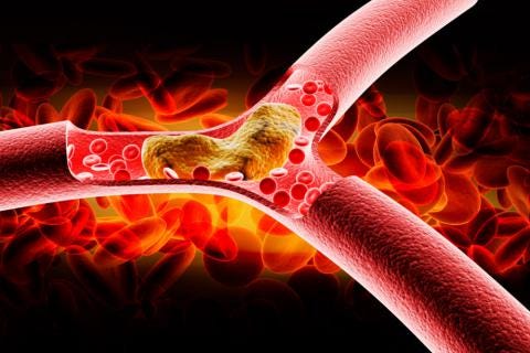 Arteriosclerosis, qué es y qué consecuencias tiene - Salud al día