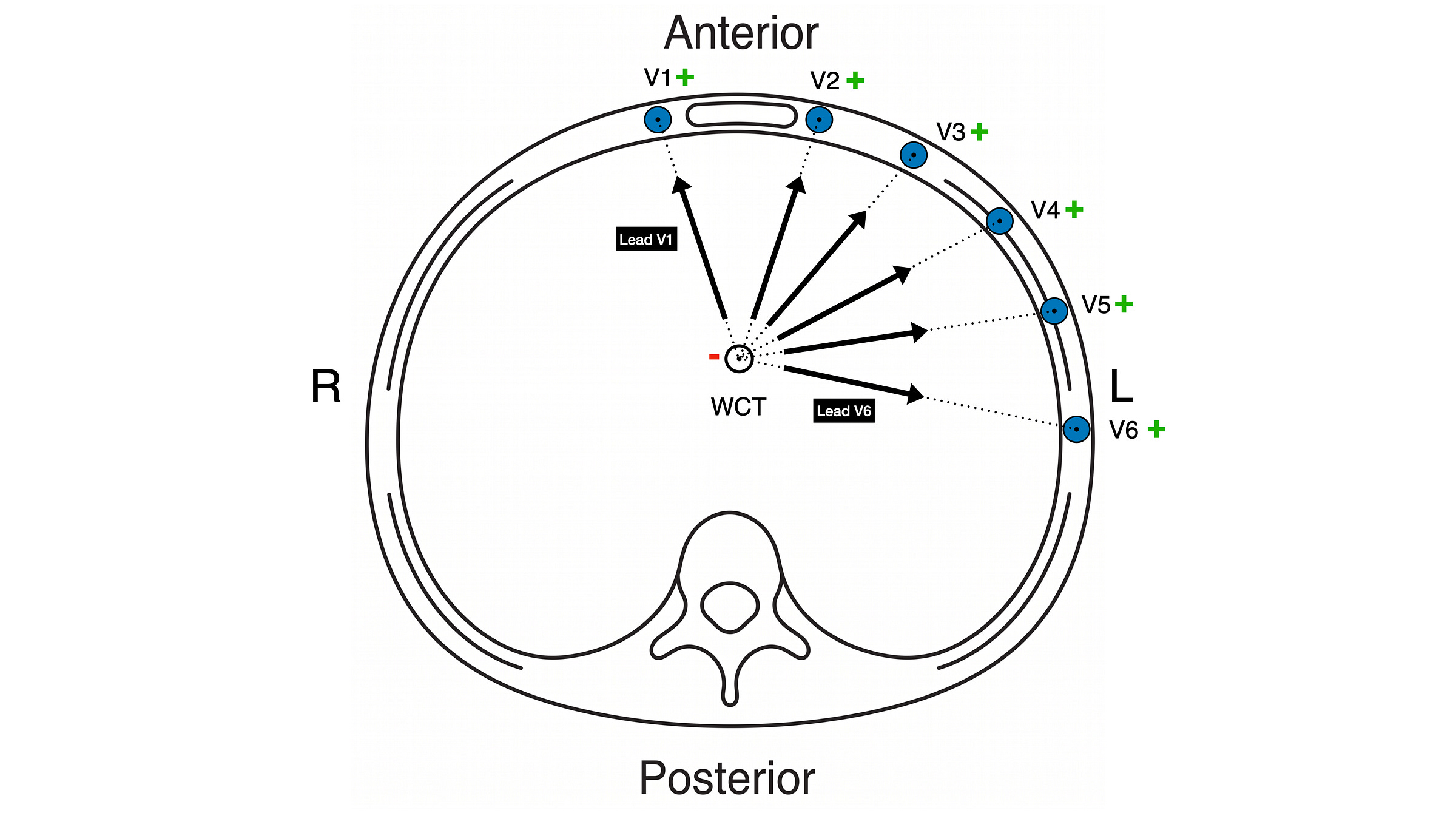 Cross-sectional view of the chest in the transverse plane, with the spine and lungs outlined, R on the left and L on the right of the figure, Anterior labelled at the top and Posterior at the bottom. Six blue dots labelled V1 to V6 sit on the chest wall, each marked with a green plus sign. A small hollow circle labelled WCT sits inside the chest and is marked with a red minus sign. Six black arrows fan out from the WCT towards each of V1-V6 and are labelled Lead V1 through Lead V6.