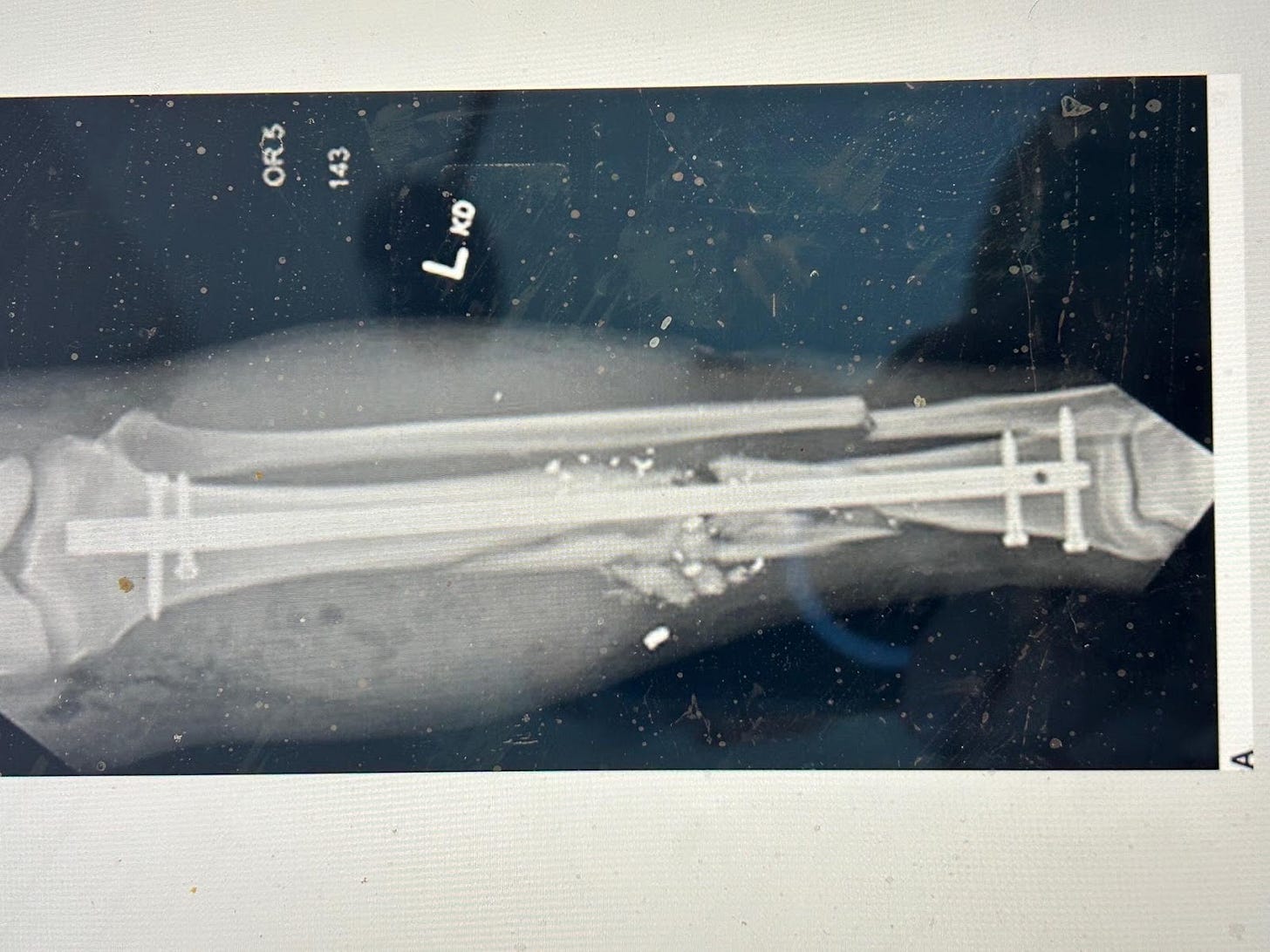 X-ray of a leg with a broken bone

AI-generated content may be incorrect.