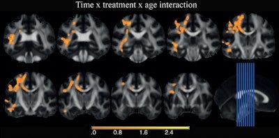 MRI shows effect of Ritalin on kids' brains | AuntMinnie