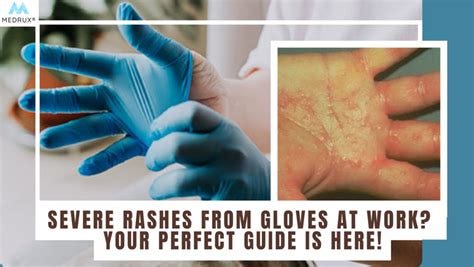 Latex Gloves Allergy
