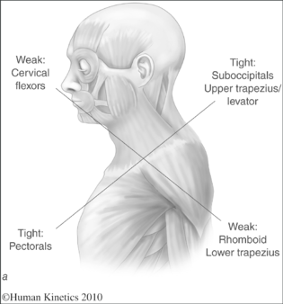 Jandas-Upper-Crossed-Syndrome-Permission-of-Human-Kinetics.png