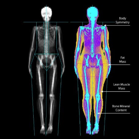 DEXA Scan, Body composition