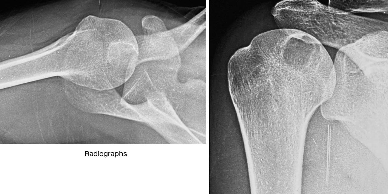 Case 6: Painful Shoulder on Anti-Tuberculous Treatment