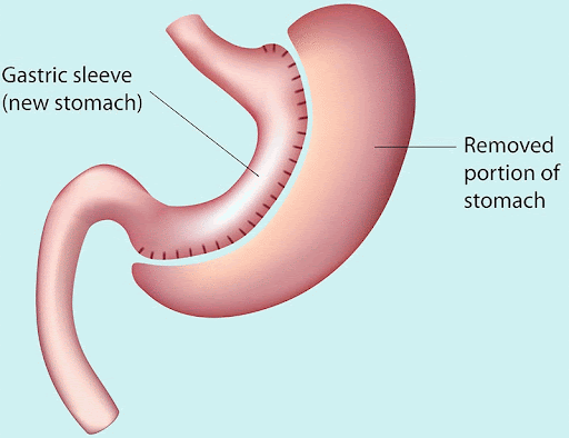 Sleeve Gastrectomy vs Gastric Bypass: Which Bariatric Surgery is Right for  You?
