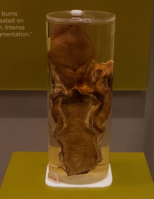 Wet specimen of a damaged trachea and larynx preserved in a jar.