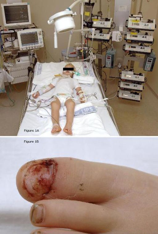 This unvaccinated child got tetanus after a toenail injury! 