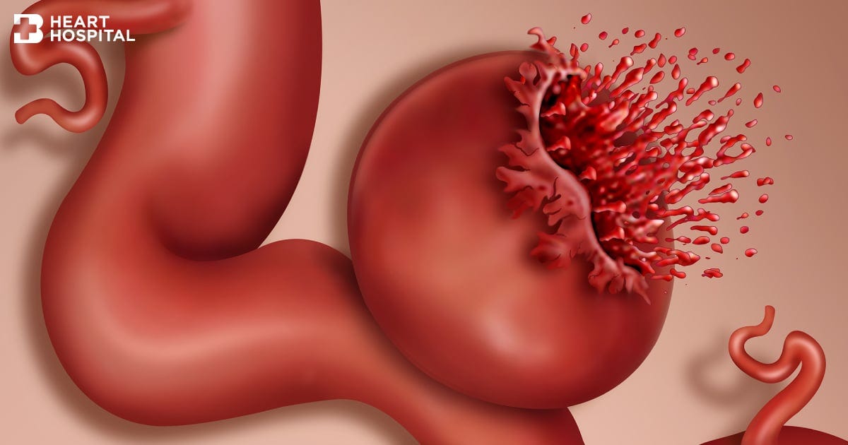 The rupture of aortic aneurysms: A medical emergency that might lead to sudden cardiac death | Bangkok Heart Hospital The rupture of aortic aneurysms: A medical emergency that might lead to sudden cardiac death | Bangkok Heart Hospital