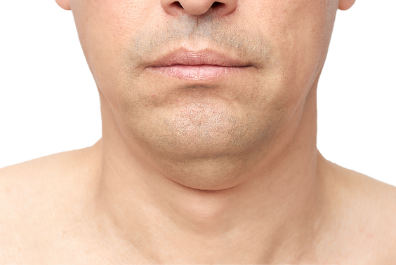 Double Chin Reduction Melbourne | My Body Vibes