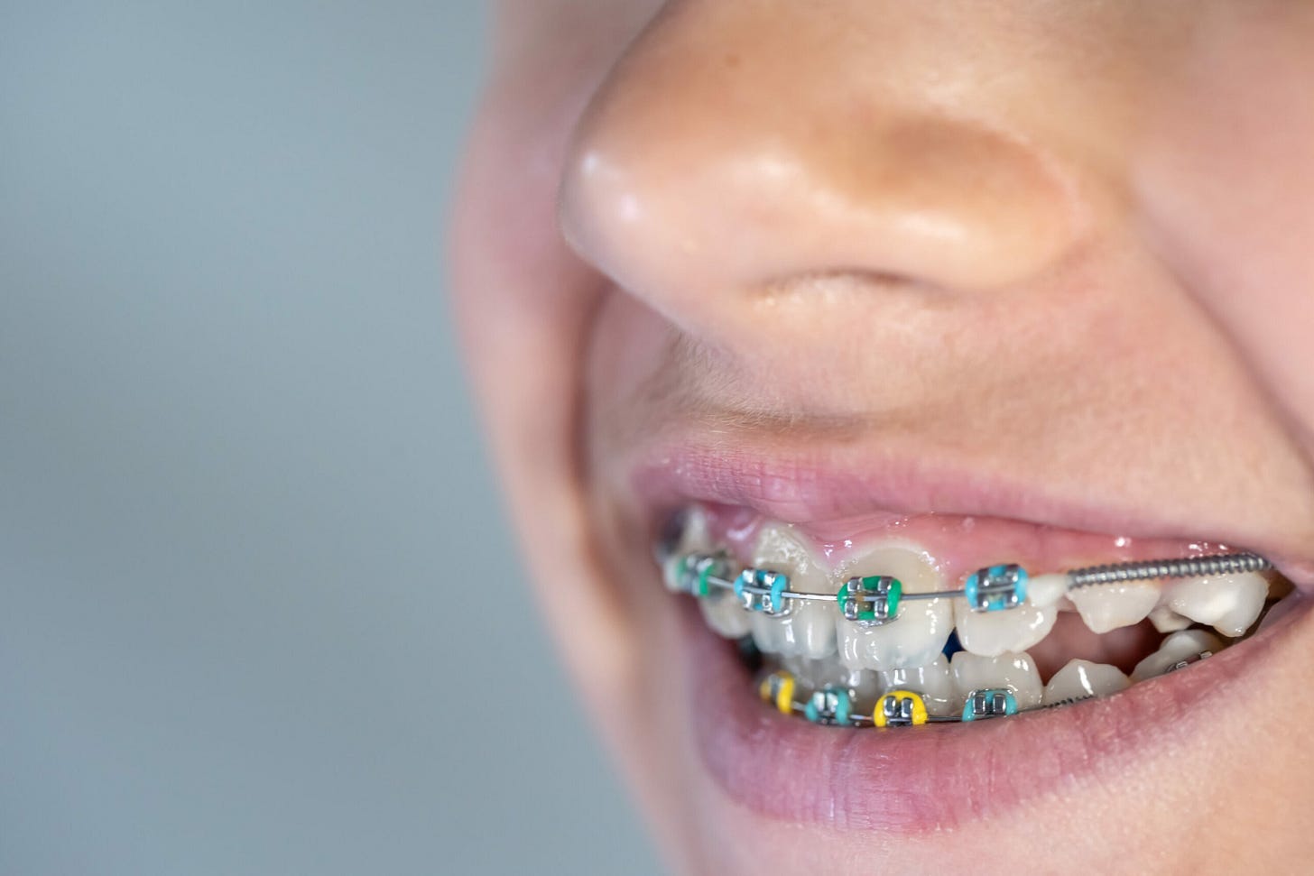 How to Put Rubber Bands On Braces | The Orthodontic Place