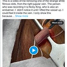 HORRIFIC: A Video of an Embalmer Removing One of the Strange White Fibrous Clots From the Right Jugular Vein 