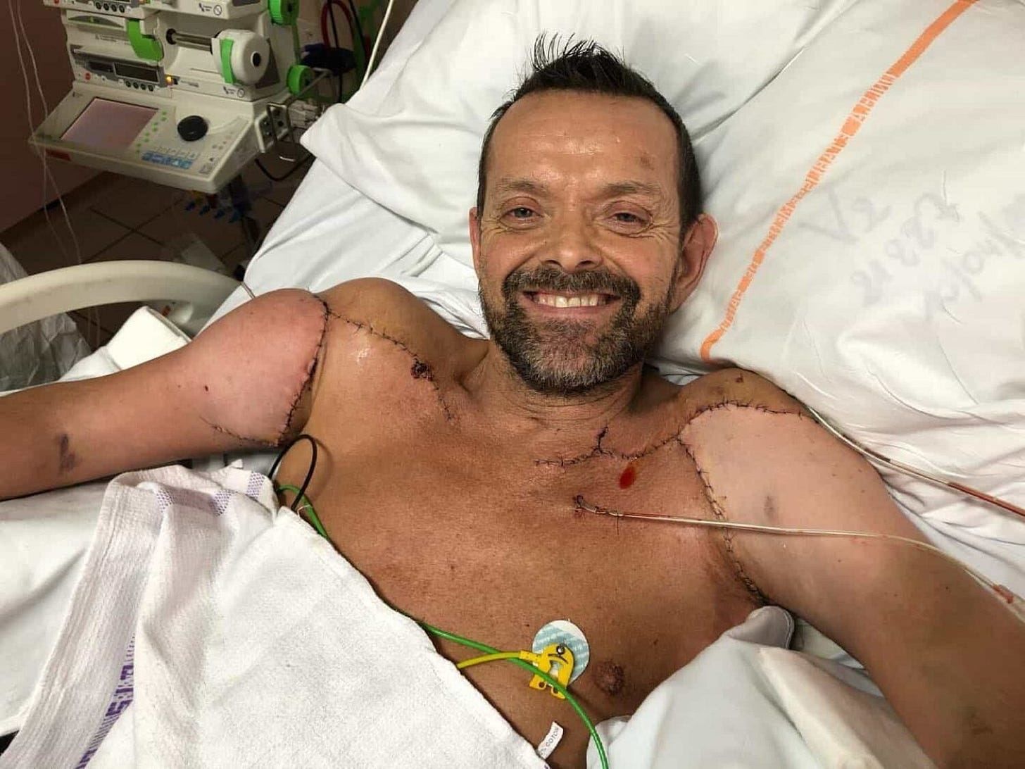 Meet the man who received the world's first double arm transplant - Positive News Meet the man who received the world's first double arm transplant - Positive News
