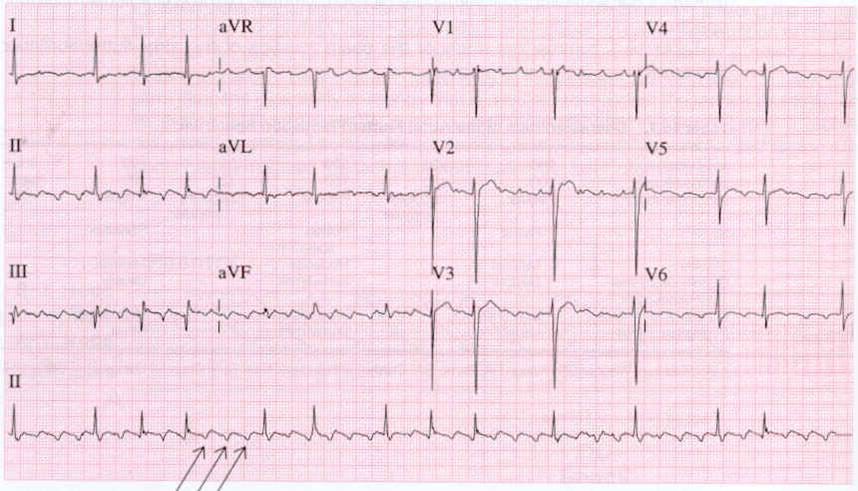 Atrial flutter with a variable AV conduction ratio Atrial flutter with a variable AV conduction ratio