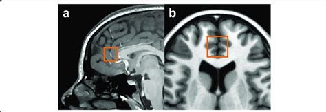 Pregenual anterior cingulate cortex (ACC) voxel. a Sagittal view; b... | Download Scientific Diagram