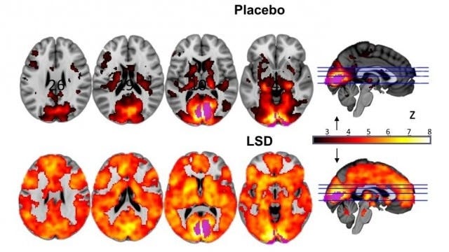LSD frees mind to be more like a baby's, brain scans show with drug linked to improvements in 'well-being' - ABC News LSD frees mind to be more like a baby's, brain scans show with drug linked to improvements in 'well-being' - ABC News