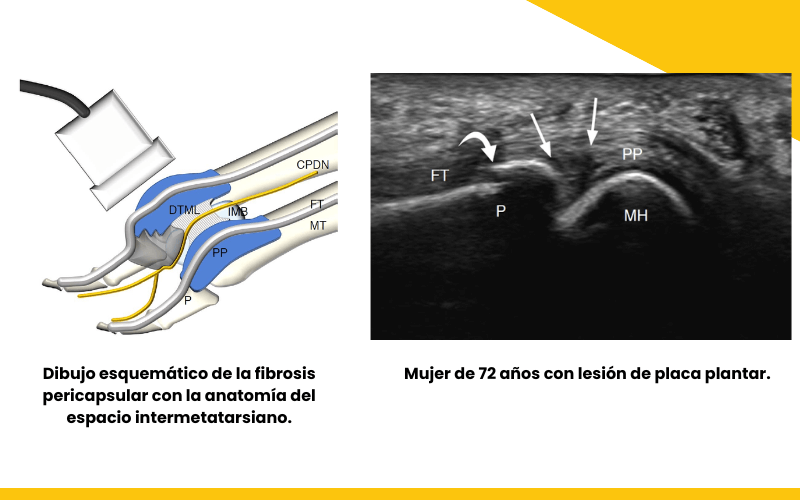 8. Placa plantar ecografia tempo formacion.png
