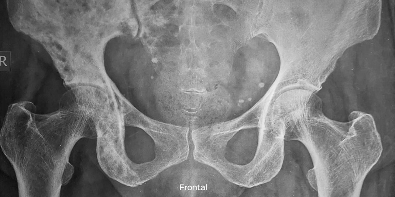 Case 37: A Sclerotic Hemipelvis
