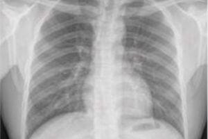 Normal chest X-ray