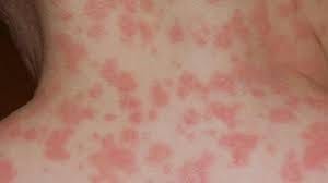 Amoxicillin Rash: How to Identify and Treat