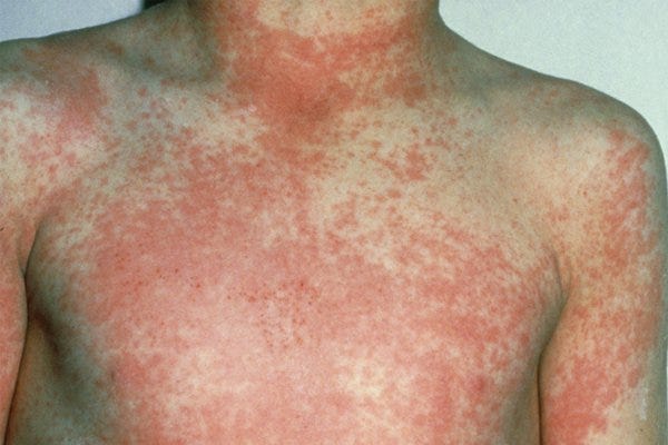 Scarlet fever - NHS