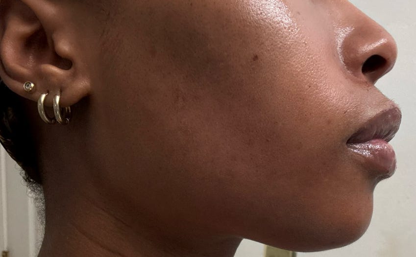 Cheeks Micro Day 437: I’m starting to see the fruits of microneedling!!