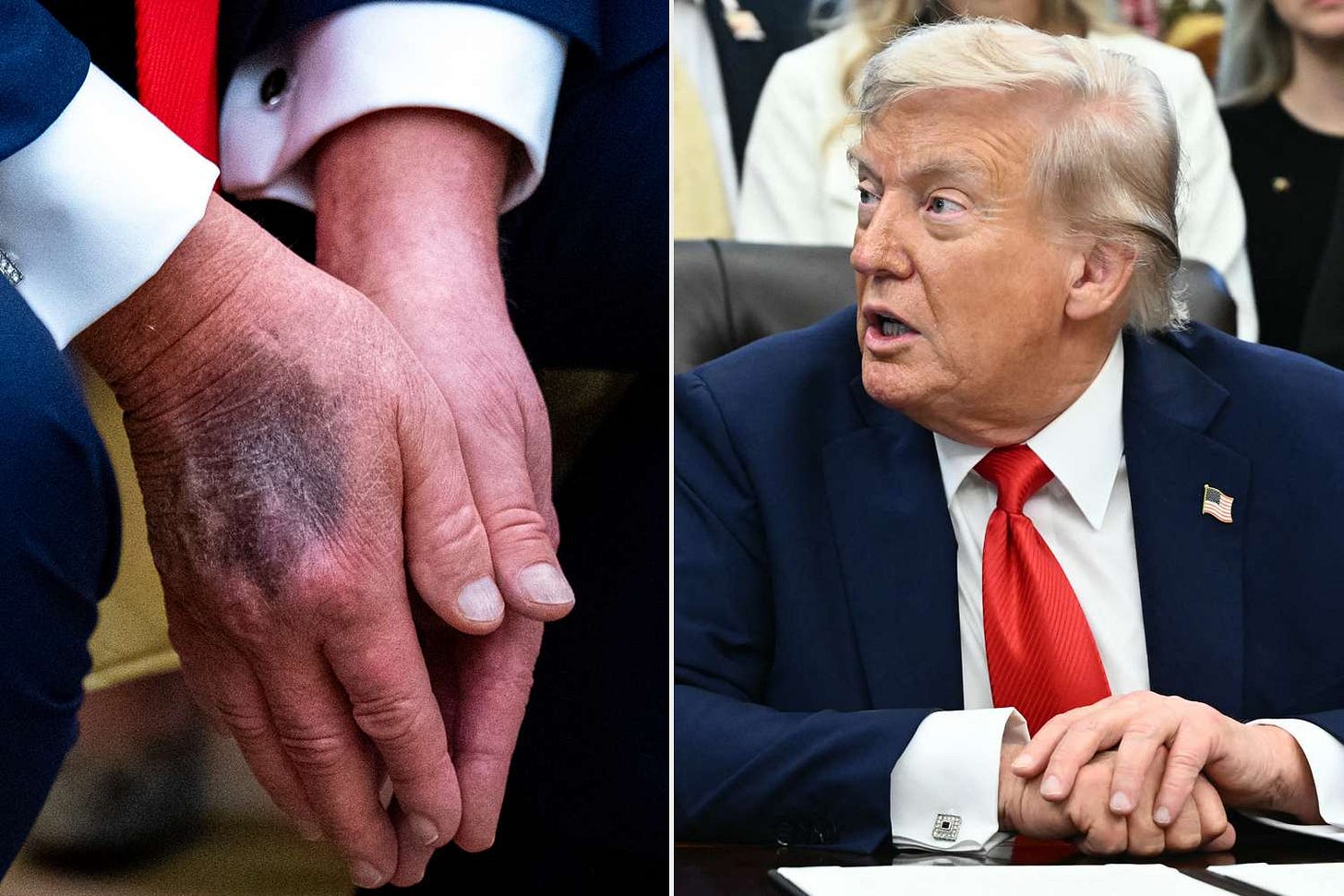 Trump Reveals Bruised Hand Without Makeup amid Online Speculation About His  Health