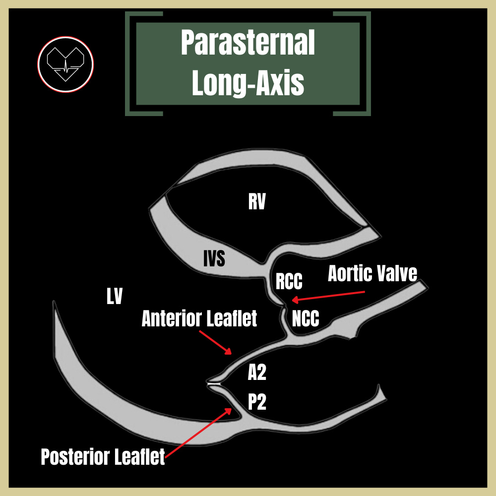 Mitral Valve: Beyond the Basics - by Alex C.